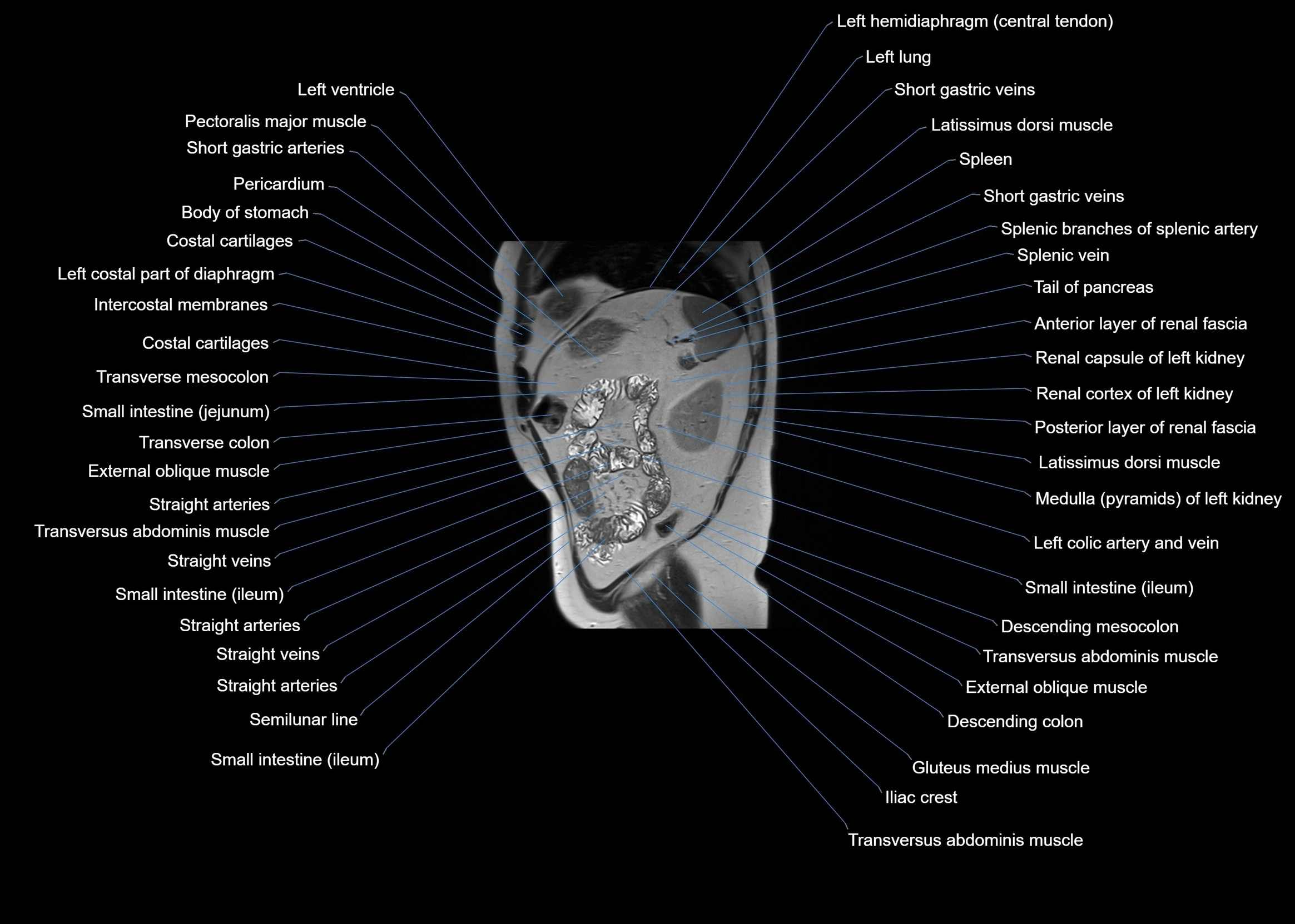 MRI abdomen sagittal cross sectional anatomy  radiology  image-img-00001-00055.webp